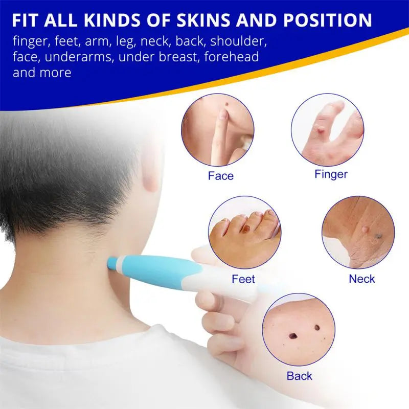 Auto Skin Tag Mole Wart Removal Kit
