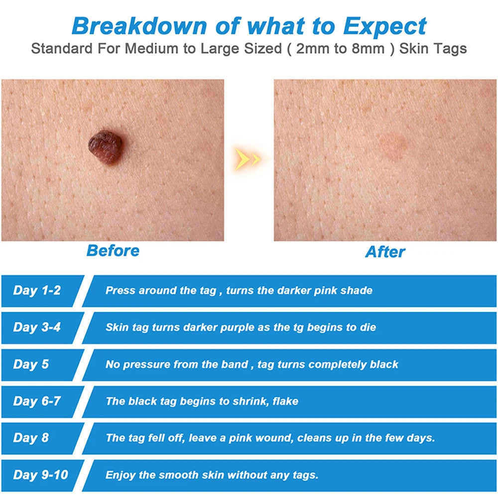 2 IN 1 Auto Micro Skin Tag Remover Device Standard